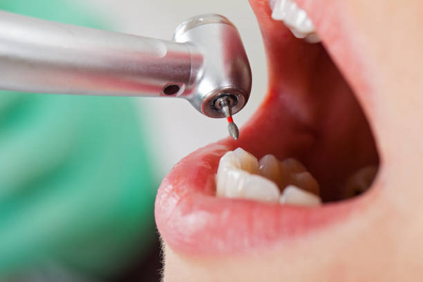Best Emergency Dental Care for Broken or Chipped Teeth in Chattanooga, TN